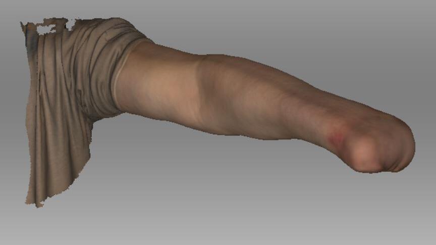 Texturmaterial des Scans in 3D eines Armstumpfs nach einer Amputation