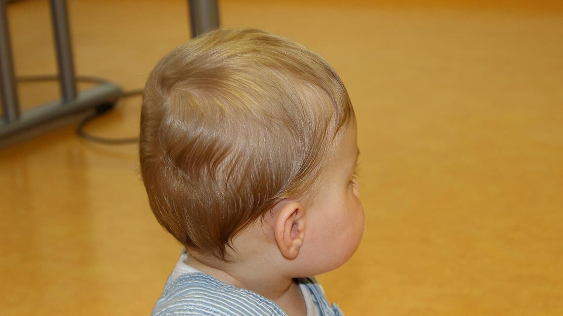 Korrigierte Schädelform eines Säuglings als Ergebnis einer erfolgreichen Helmtherapie