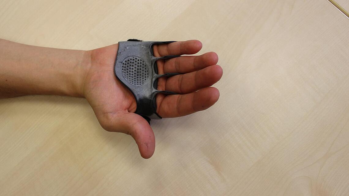 Finger werden durch eine Ulnardeviationsorthese aus dem 3D-Drucker geführt und die Fehlstellung korrigiert