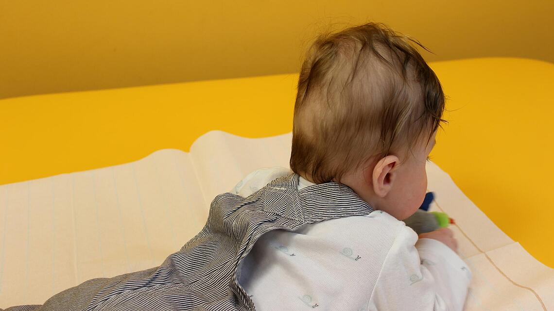 Säugling mit Schädeldeformität in Form eines abgeflachten Hinterkopfs