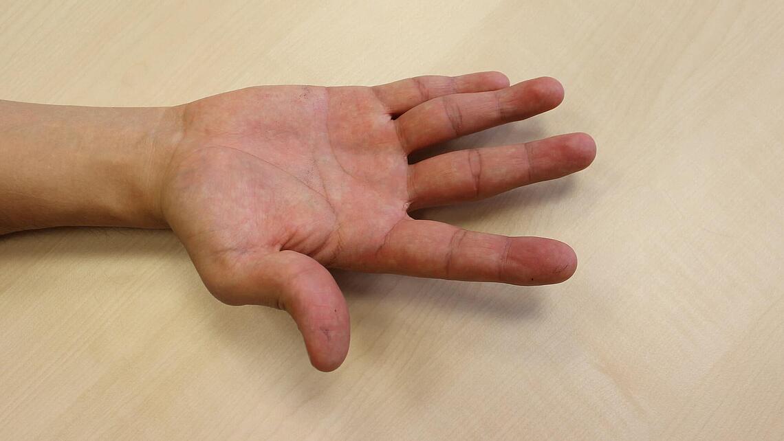 Fehlstellung der Finger als Ausgangspunkt für den Einzatz einer Ulnardeviationsorthese
