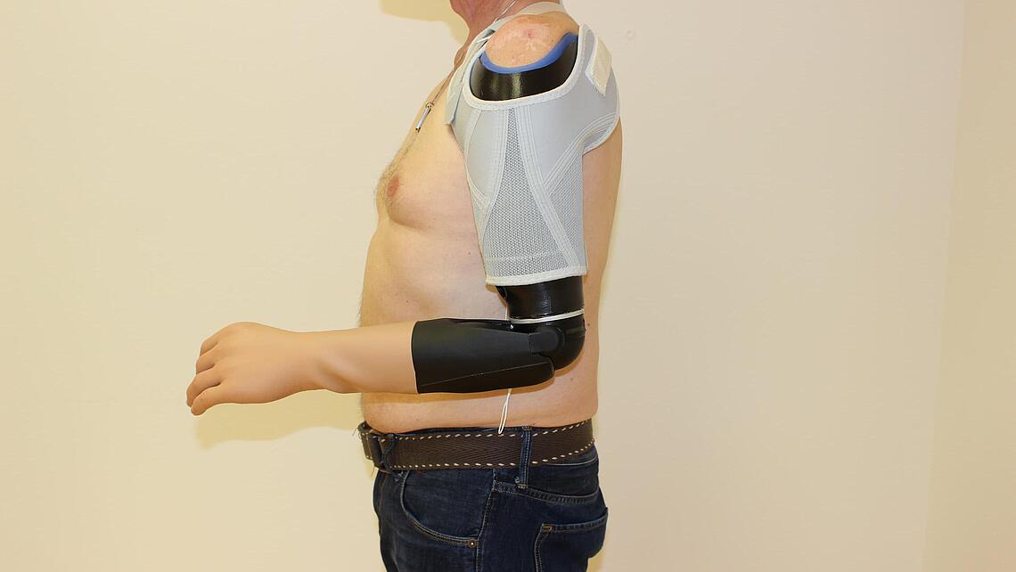 myoelektrische Oberarmprothese angezogen